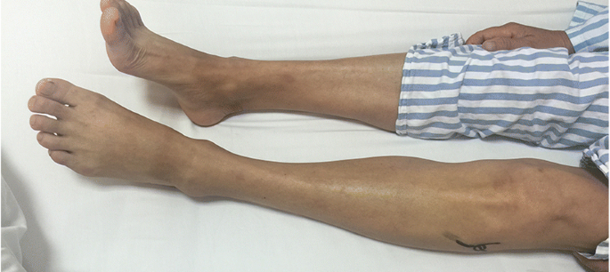 An example of foot drop