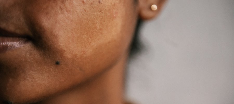 A skin patch on the cheek of a woman's face