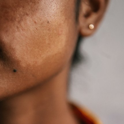 A skin patch on the cheek of a woman's face