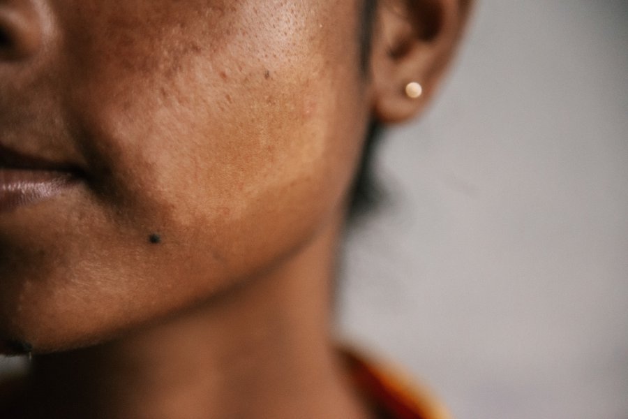 A skin patch on the cheek of a woman's face