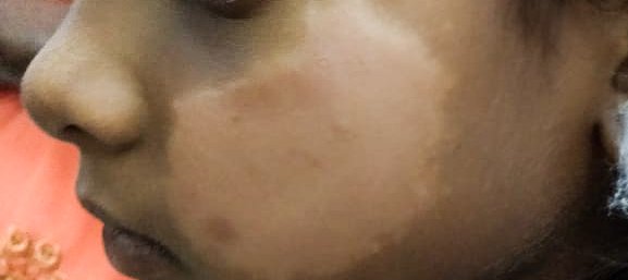 A leprosy skin patch on a young girl's face