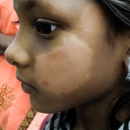 A leprosy skin patch on a young girl's face