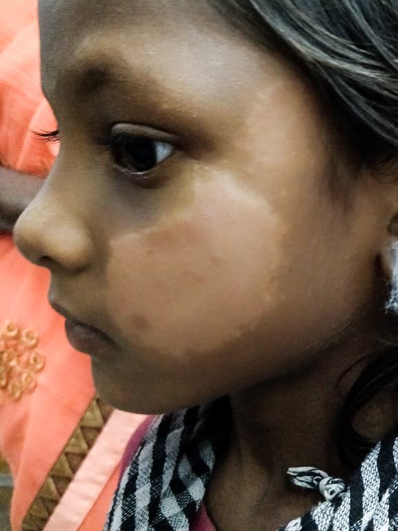 A leprosy skin patch on a young girl's face