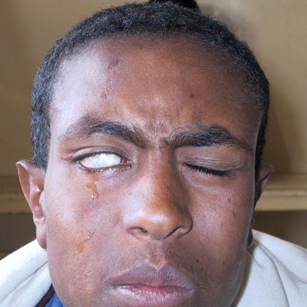 man is trying to close his eyes, but the right eye cannot close as the muscle is paralysed as a result of leprosy