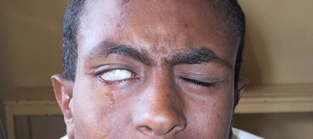 man is trying to close his eyes, but the right eye cannot close as the muscle is paralysed as a result of leprosy