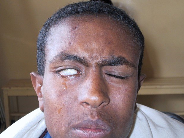 man is trying to close his eyes, but the right eye cannot close as the muscle is paralysed as a result of leprosy