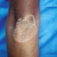 An example of a leprosy skin patch