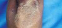 An example of a leprosy skin patch