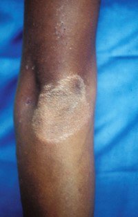 An example of a leprosy skin patch
