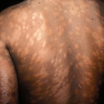 Leprosy skin patches