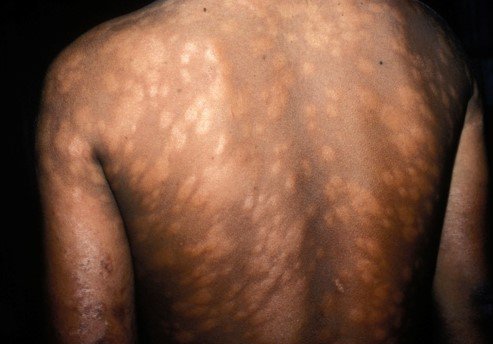 Leprosy skin patches